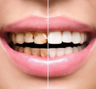 Full Mouth Rehabilitation