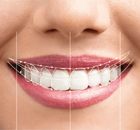 Smile Makeover